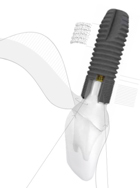 ふかつ歯科 アストラテックインプラント